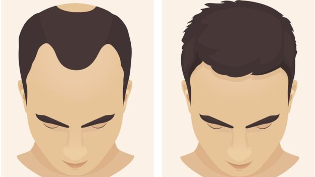 alopecia androgenica hombre