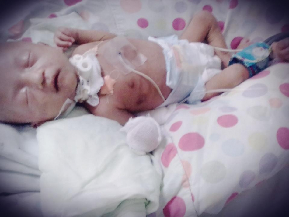 Carazo: bebé prematura necesita ayuda para seguir viviendo 