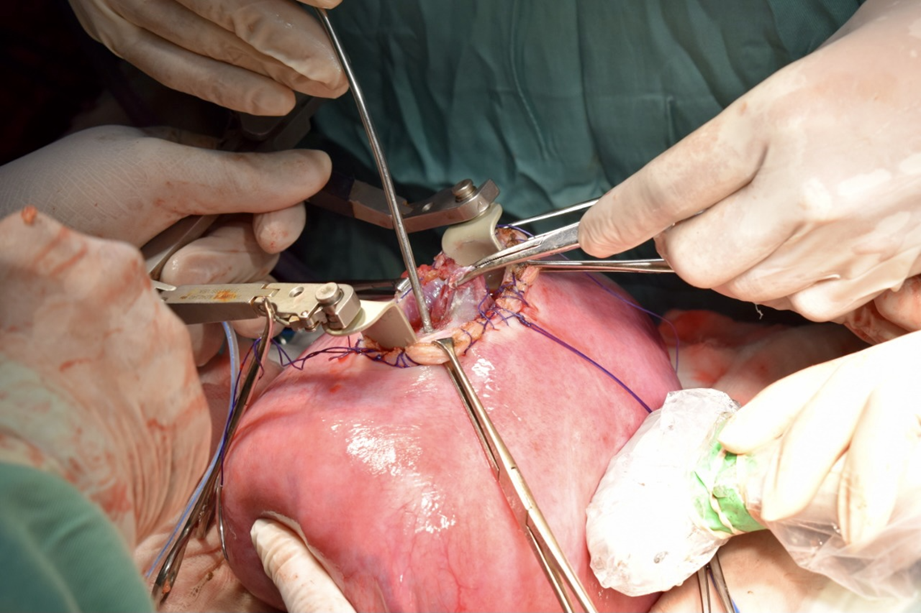 Nicaragua:realizan primera cirugía que corrige la espina bífida desde el vientre materno