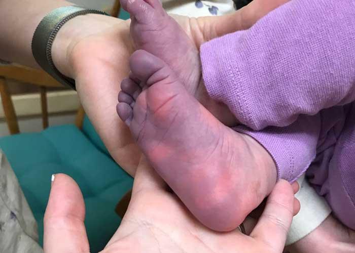 Niña de 5 meses con pies y manos morados tras padecer covid-19