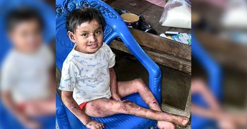Niño de 8 años sufre severa enfermedad, conocida como "piel de mariposa"