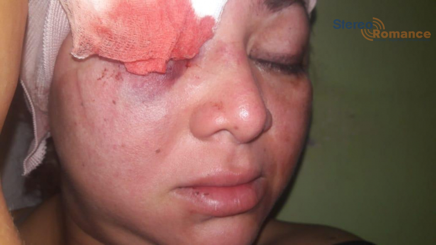 Joven puede perder el ojo tras golpiza policial en Masaya