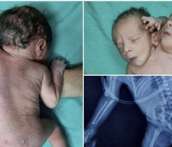 Sorprendente: Nace bebé con dos cabezas, tres brazos y dos corazones