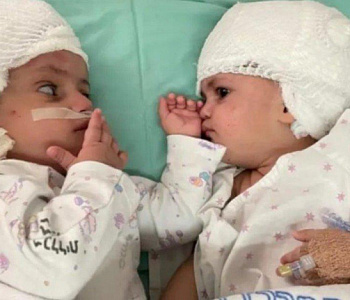 Operación exitosa: Separan a gemelas que venían unidad de la cabeza 