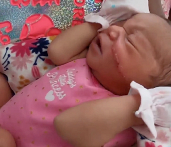 Cortan la cara de una bebé durante una cesárea de emergencia